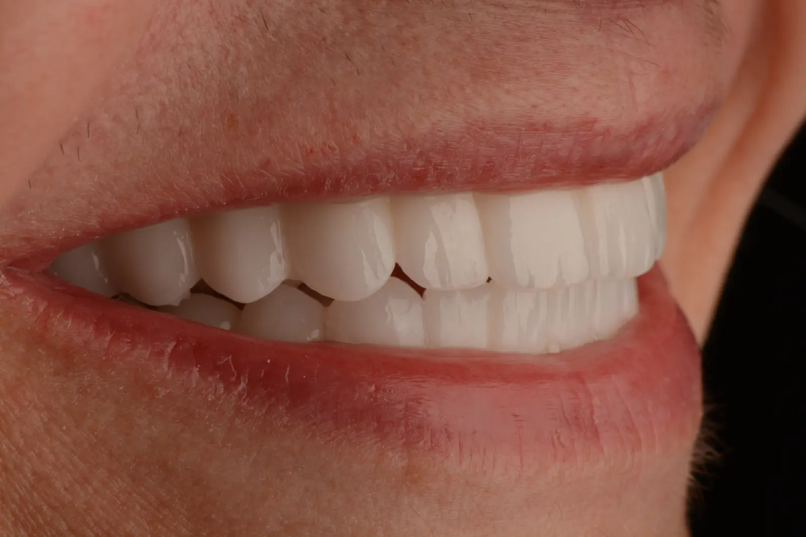 Jakie powikłania mogą wystąpić po wszczepieniu implantu zęba?