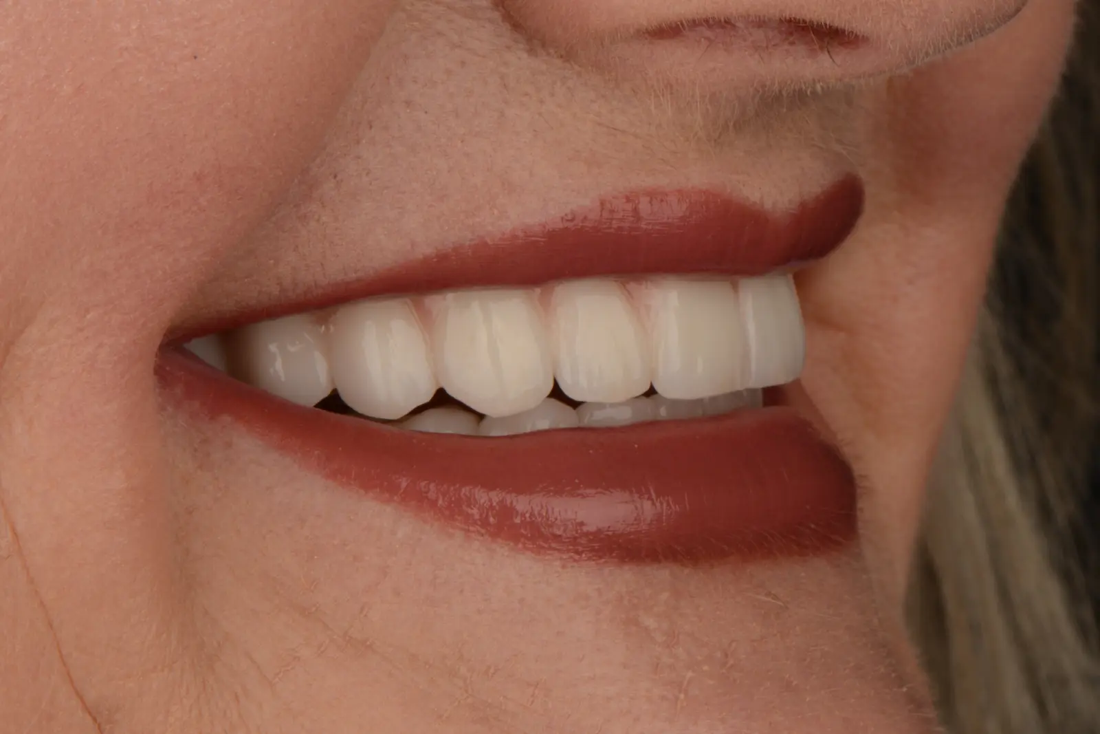 Odrzucenie implantu zęba – fakty i mity